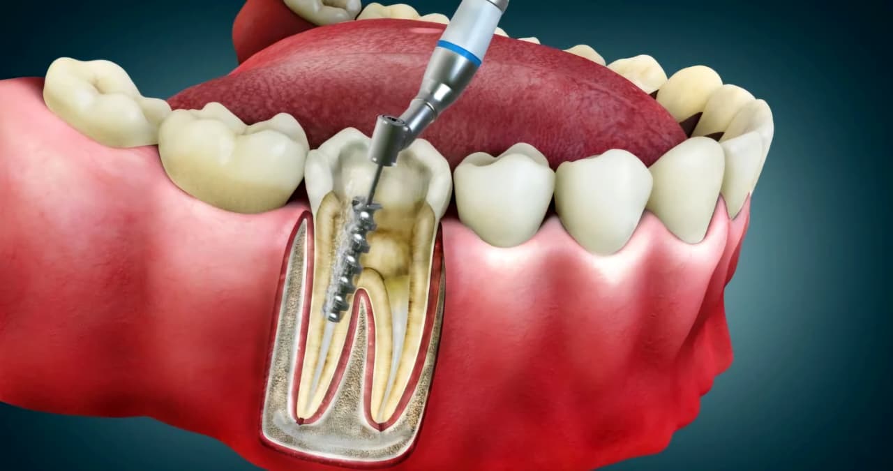 Root Canal Treatment